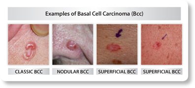 early basal cell carcinoma nose