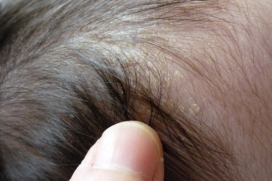 Cradle cap best sale adults cure