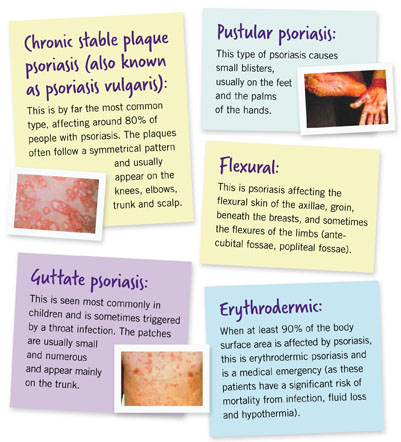 Psoriasis  Dr. Kenton Busch