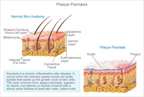can psoriasis be surgically removed